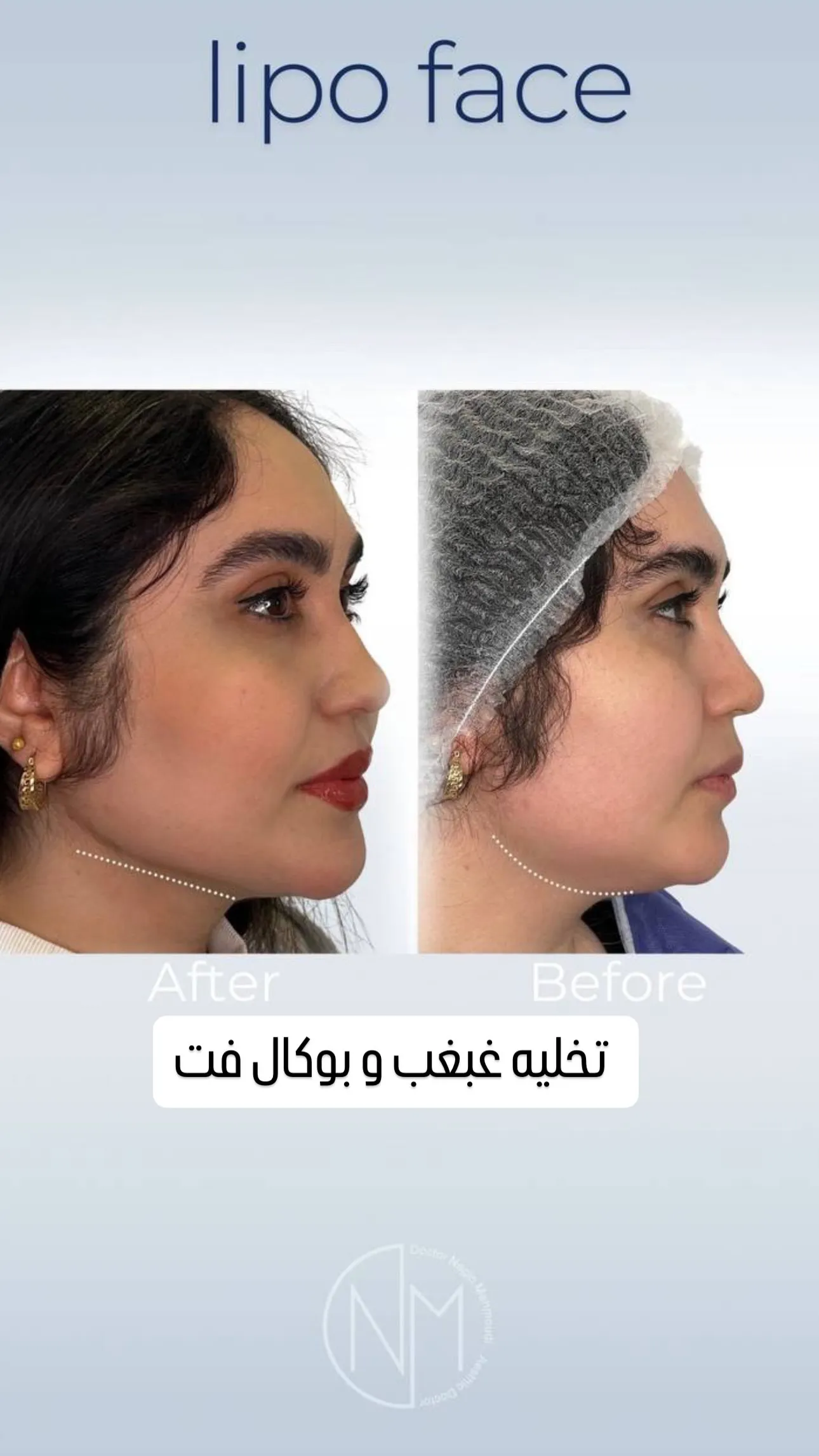 نمونه کار 7 - کانتورینگ دائمی با جراحی