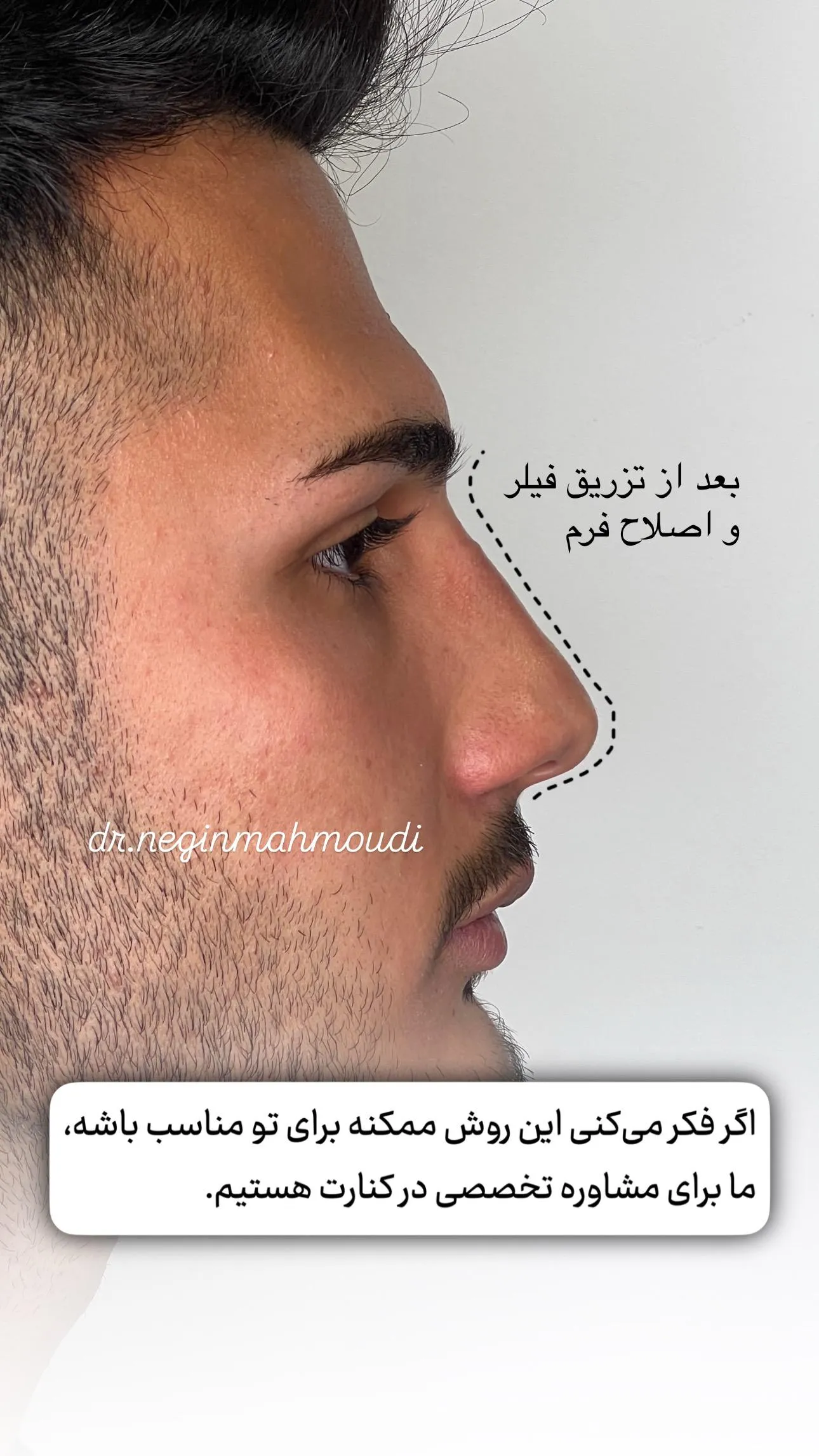 نمونه کار 2 - فیلر بینی