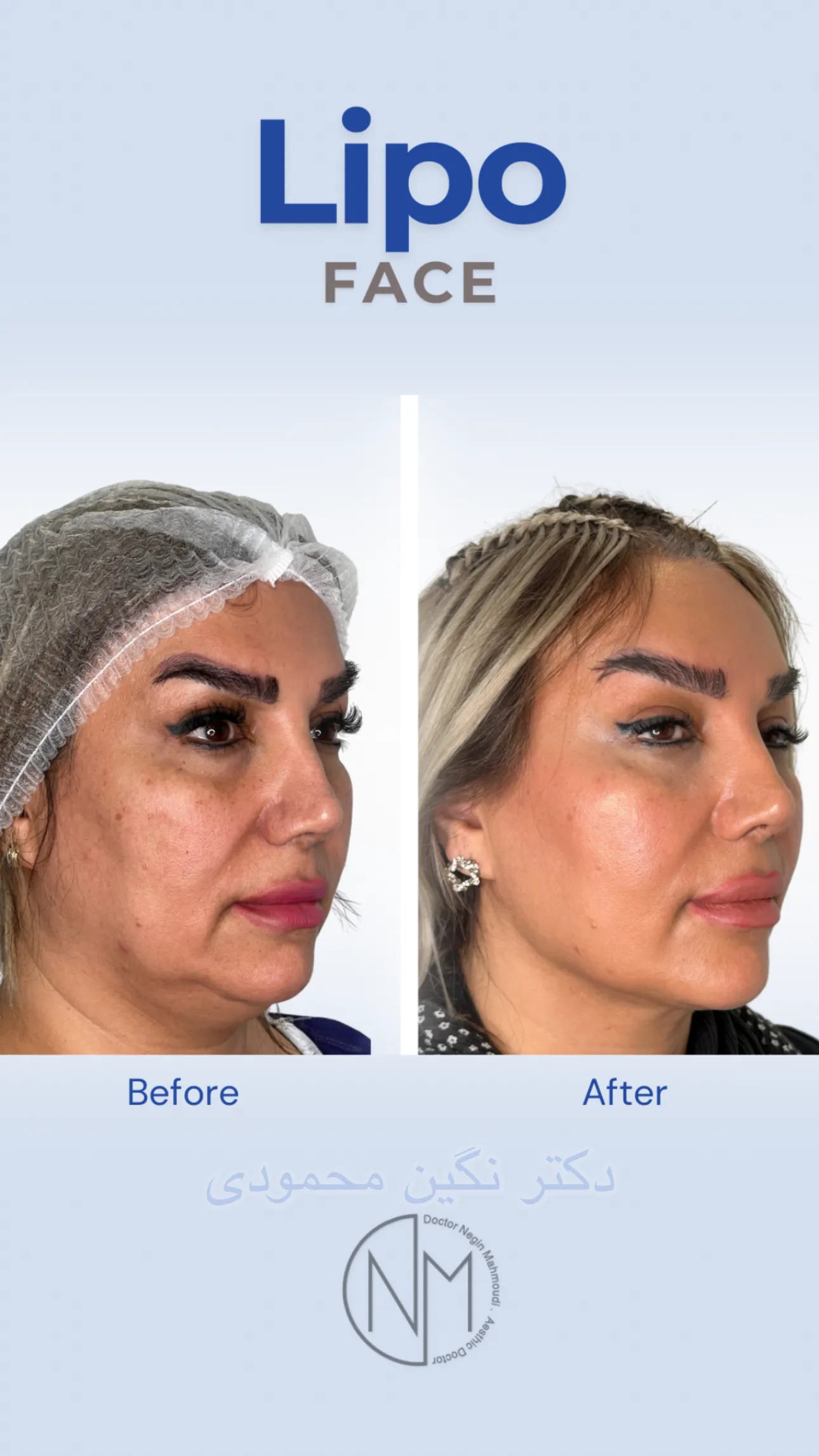 نمونه کار 2 - کانتورینگ دائمی با جراحی